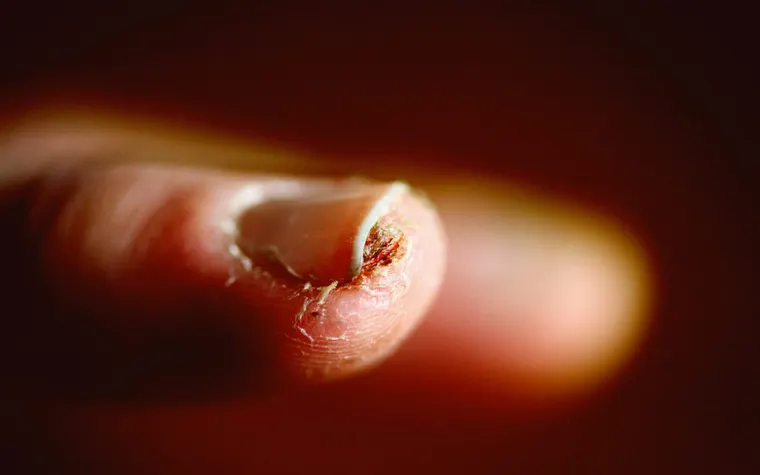 Clear Nails Ahead: The Most Effective Treatments for Nail Fungus You Need to Know