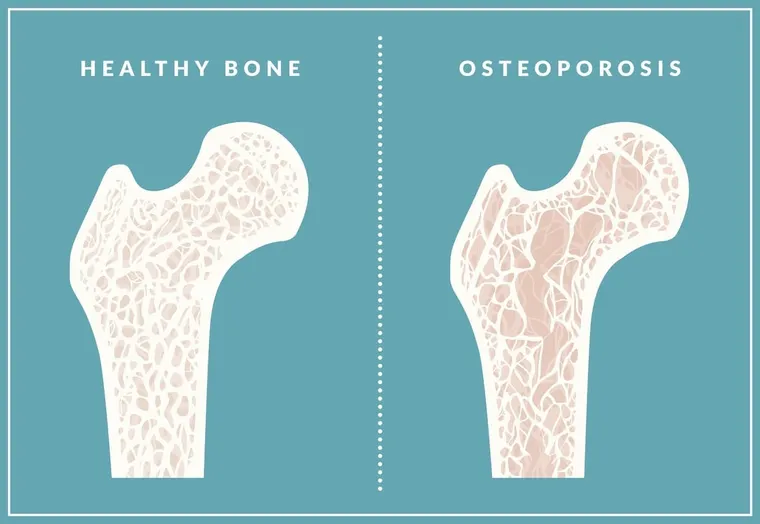 Stronger Bones Ahead: Effective Osteoporosis Treatments to Prevent Fractures and Boost Mobility