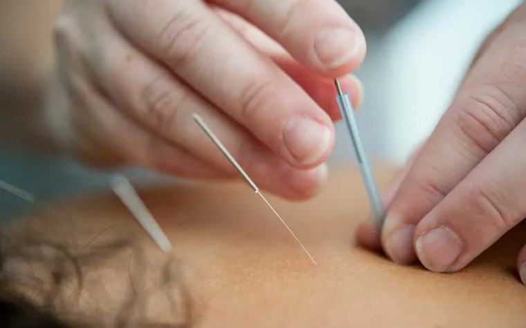 Acupuncture Treatments: Ancient Healing Techniques for Modern Health and Lasting Relief