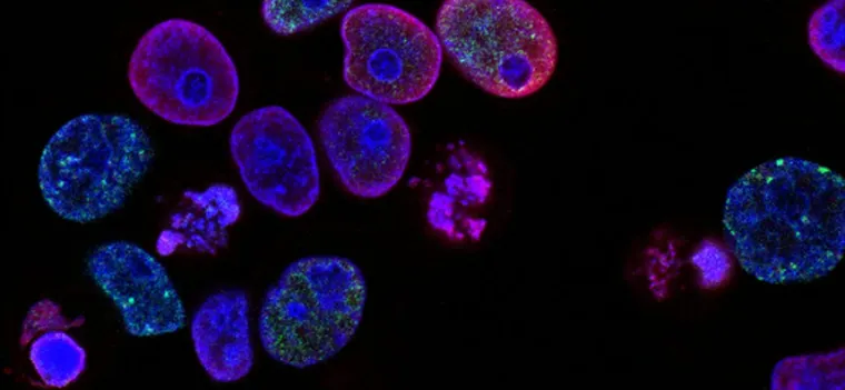 Prostate Cancer Treatment Options in 2025: A Complete Guide