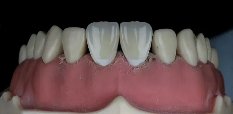 How to Find Low-Cost Dentures in 2025: Guide