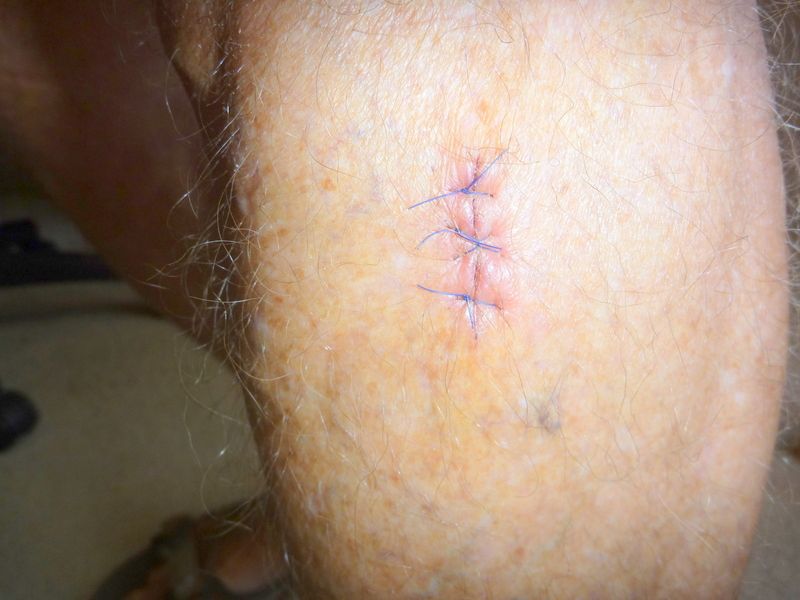 Minor surgery