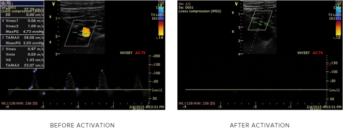 New Wearable Hemorrhage Device Created to Save Military Lives