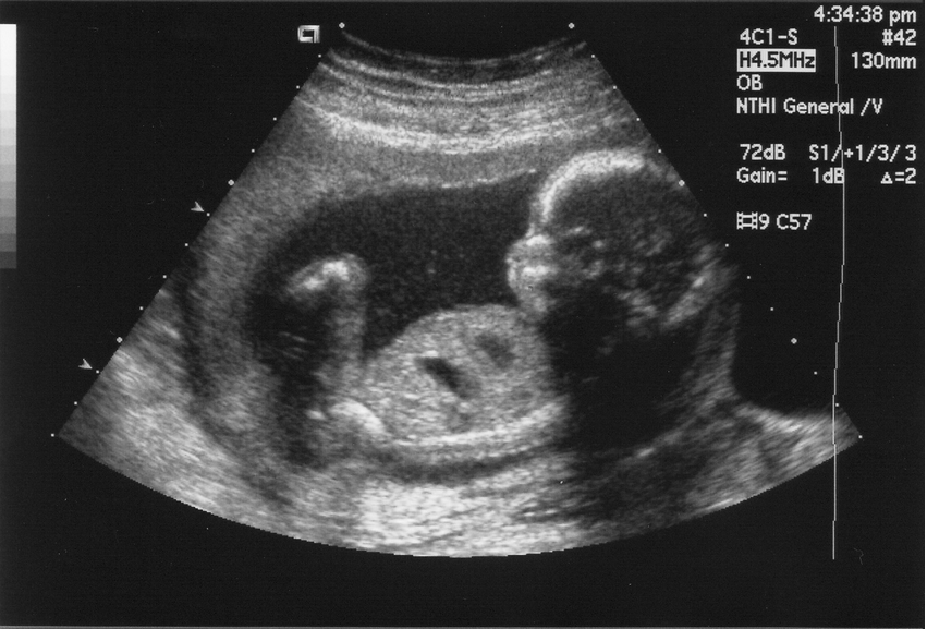 ATA's New Life Science Vertical Finds First Fundee