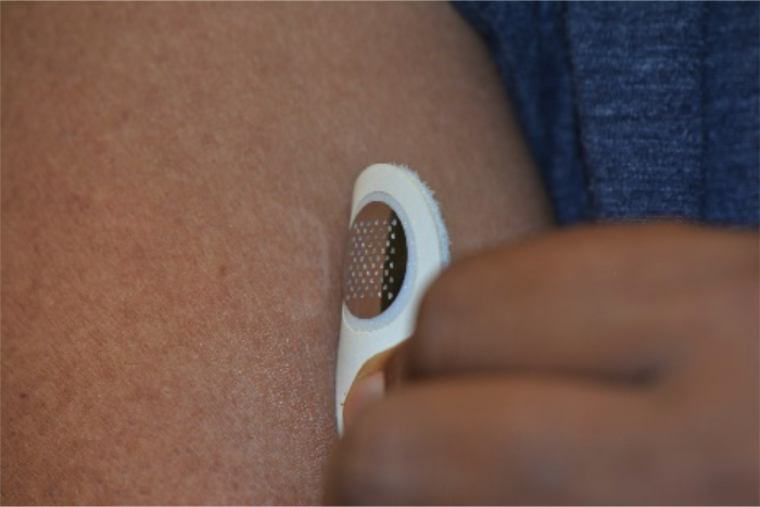 Moonlight Therapeutics Treats Peanut Allergies With A Skin Patch