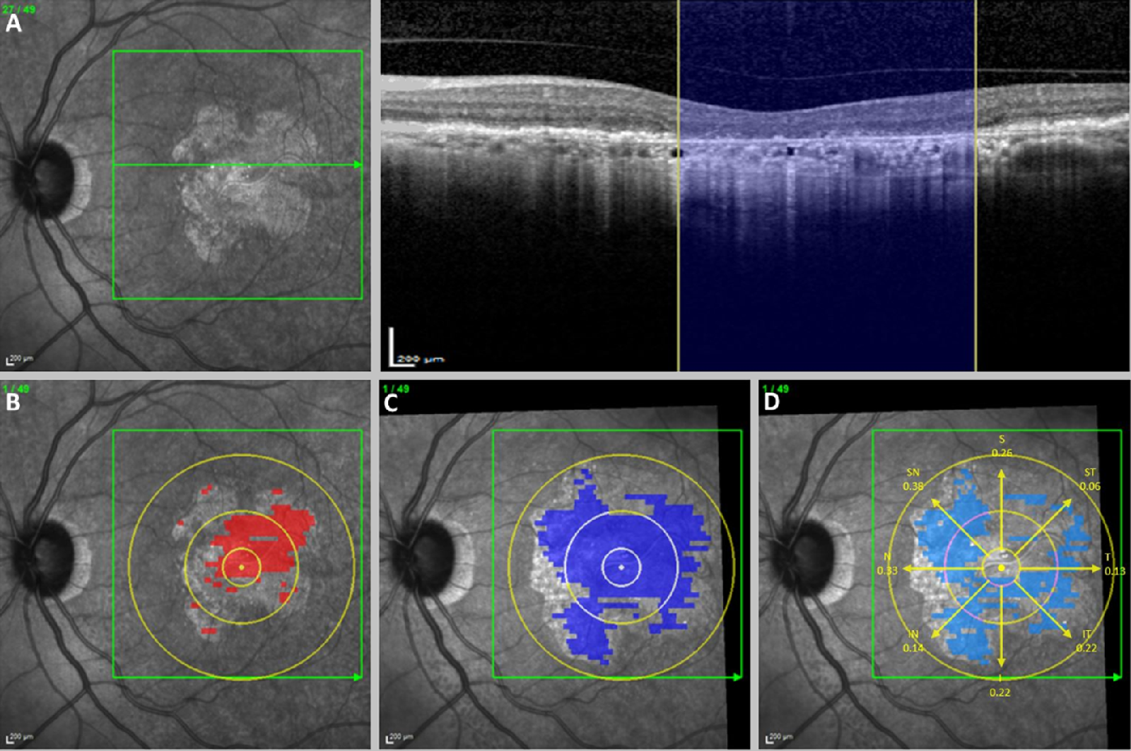 SD-OCT B-scan with the cRORA criteria marked: choroidal hypertransmission, RPE attenuation or disruption, and overlying photoreceptor degeneration