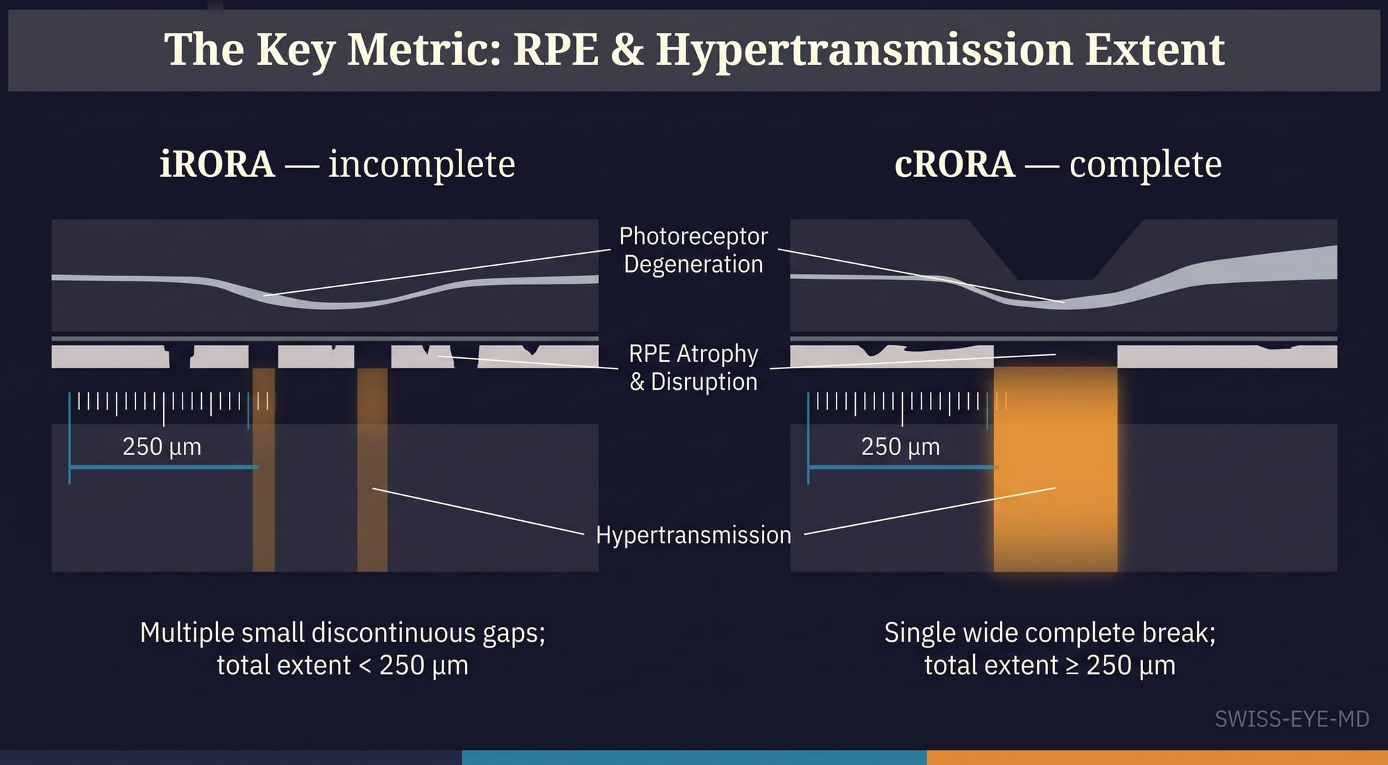 Two-panel schematic cross-section of the retina. Left (iRORA, incomplete): the RPE band has small interrupted gaps with a narrow faint column of hypertransmission below. Right (cRORA, complete): one wide continuous break in the RPE, a broad bright column of hypertransmission into the choroid, and collapse of the overlying retinal layers