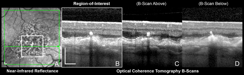 Four-panel OCT figure. Panel A is a near-infrared image of the macula with a marked region of interest; panels B, C and D are three neighbouring B-scans through it, showing subtle outer-retinal and retinal-pigment-epithelium change whose extent is hard to delimit.