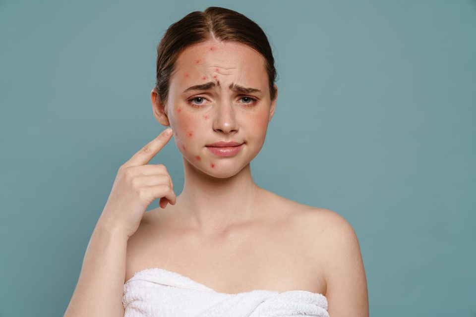 Post-Acne Marks: PIE vs. PIH. How to Identify and Fade Them!