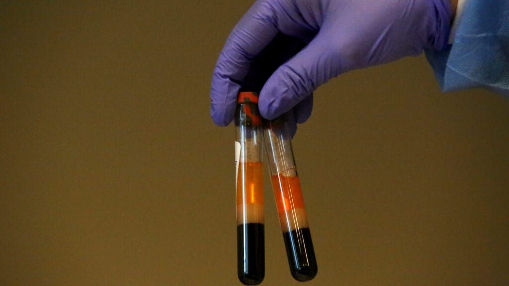 Same blood test, different results: Why isn’t this common thyroid screening reliable?