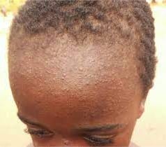 Measles In Black Babies