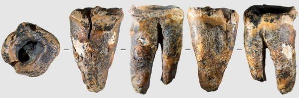 Earliest evidence for invasive mitigation of dental caries by Neanderthals