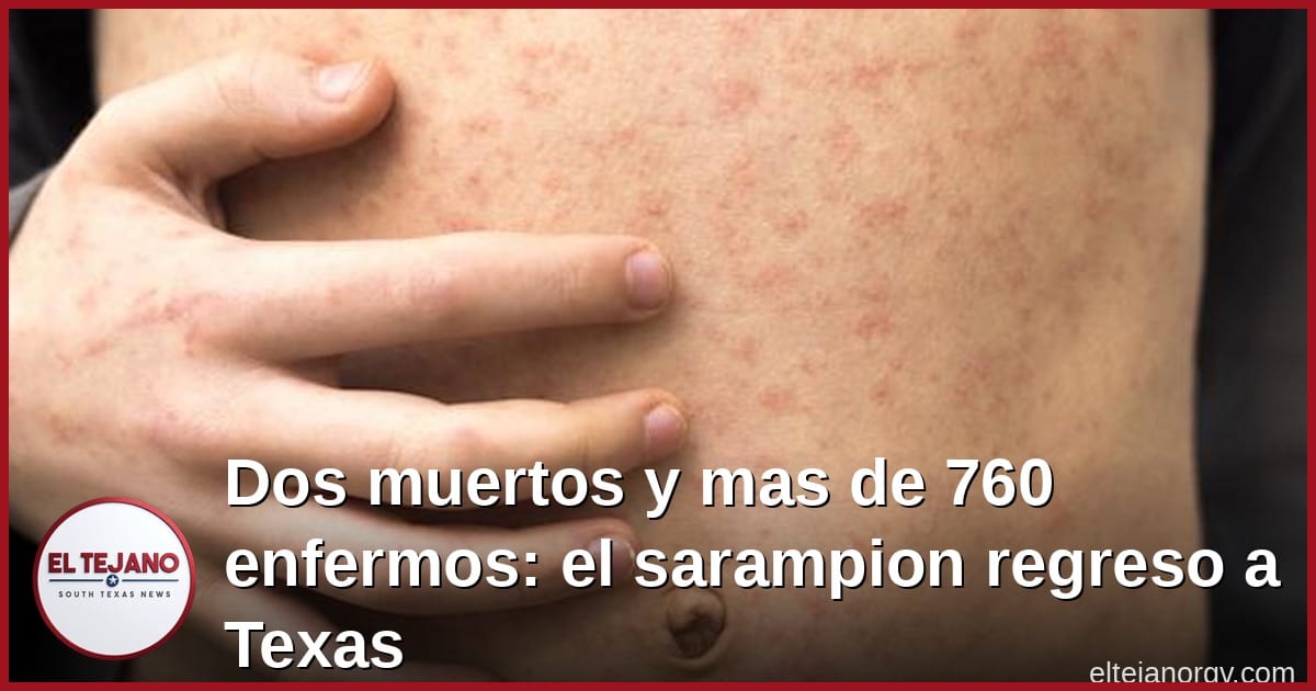 Dos muertos y mas de 760 enfermos: el sarampion regreso a Texas y la RGV debe saber esto