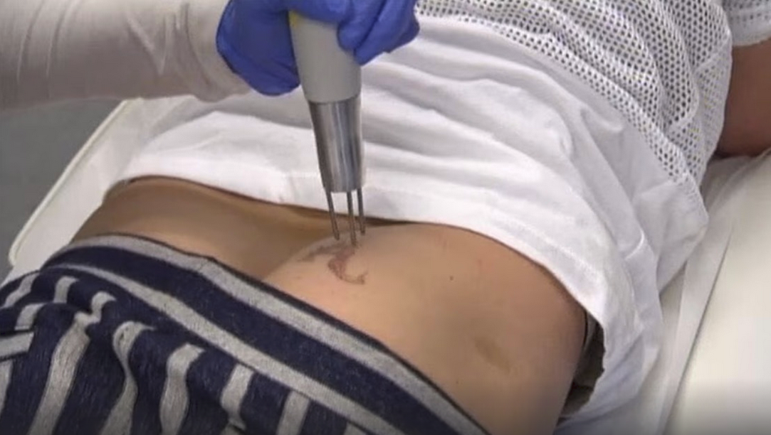 A man's backside with a horrible looking steel implement wielded by nitrile-gloved technician hovering above the "A" tattoo undergoing removal