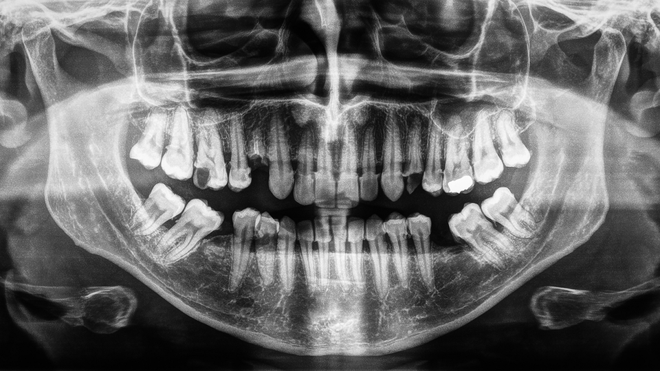 Xray pano image of human teeth and jaws