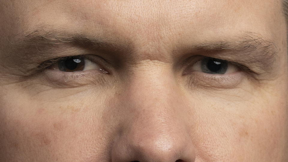 Closeup of the beady eyes and splotchy skin of Pete Hegseth, U.S. Secretary of Defense