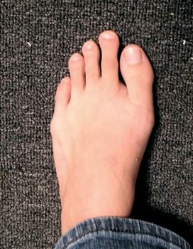 Morton's Toe (Second toe longer than the first) and Five Fingers