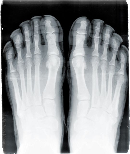 X-Rayed Vibram Five Fingers KSO Treks
