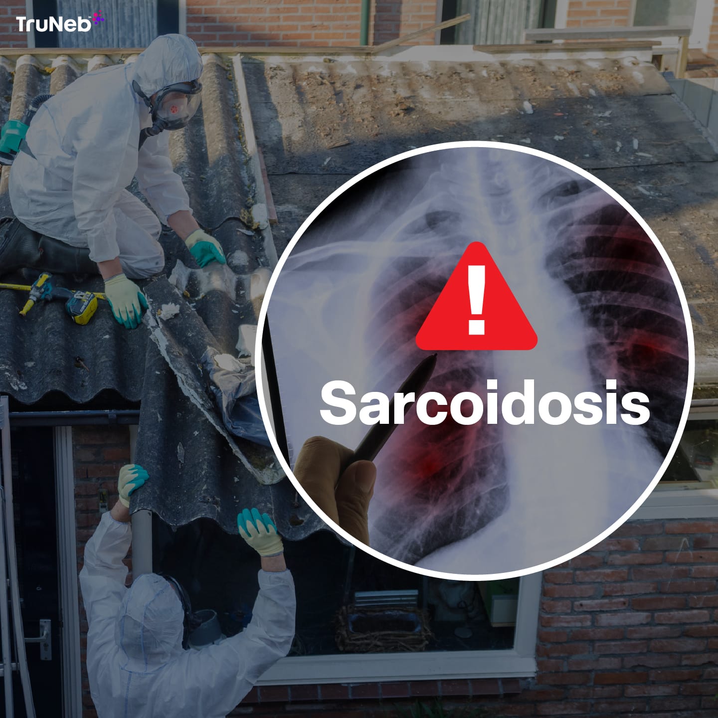 Sarcoidosis and Asbestos Exposure