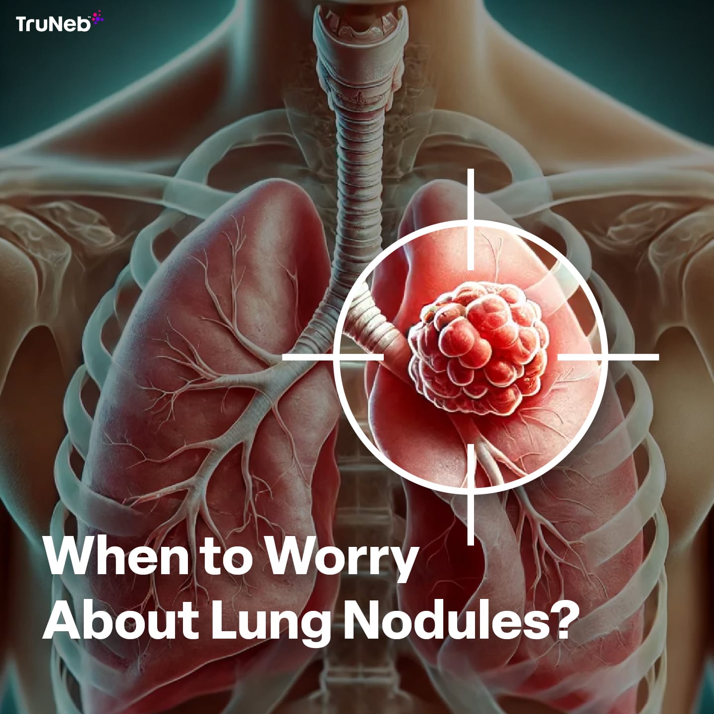 Lung Nodules