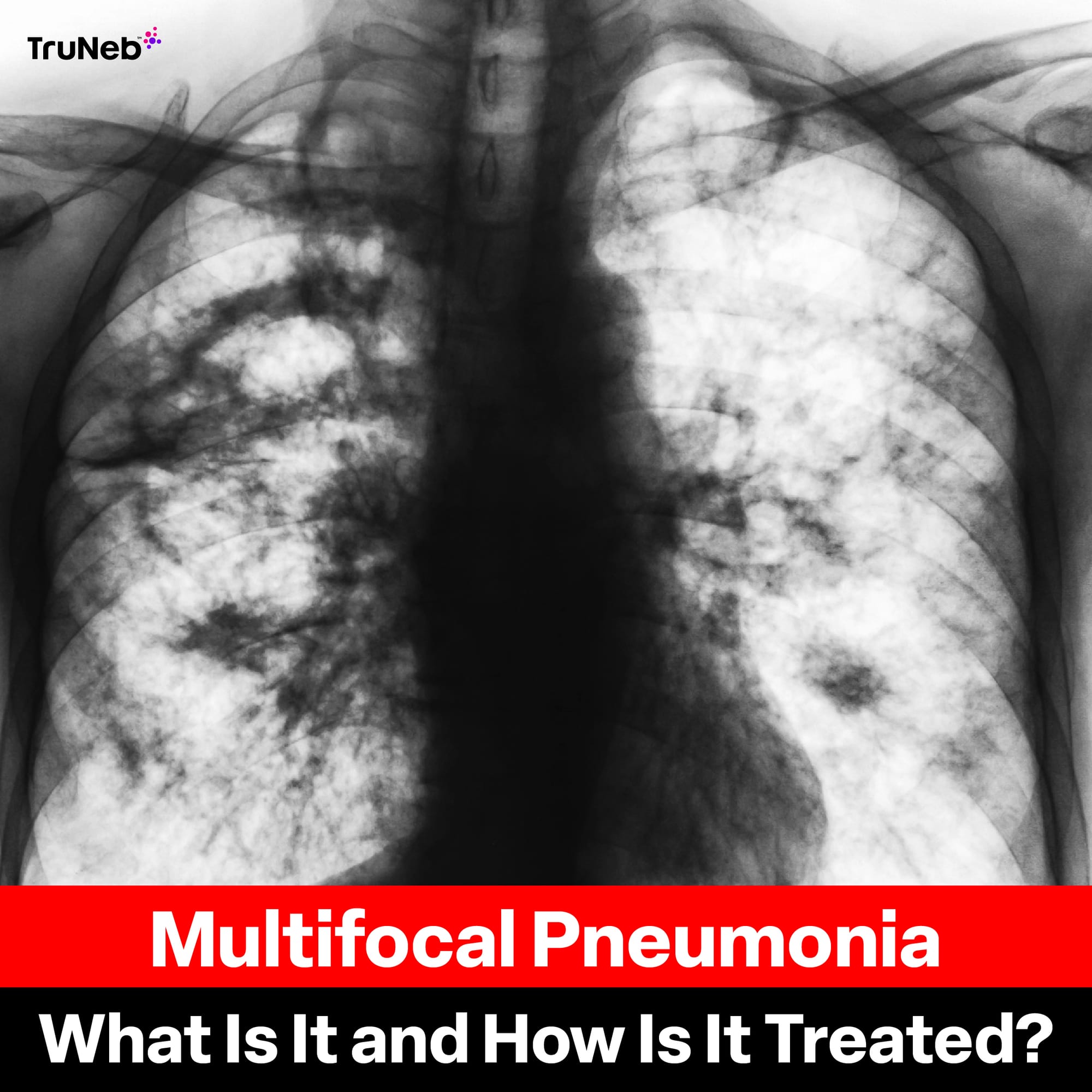 Everything you need to know about Multifocal Pneumonia