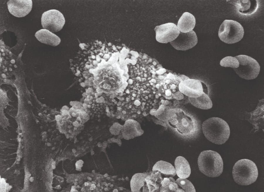 Hedgehog helps cancer stem cells survive