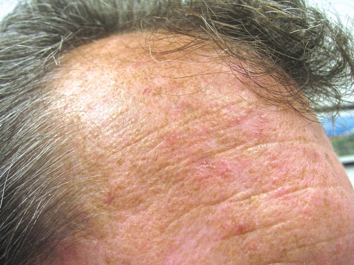 Seeing the light: Acting against actinic keratosis