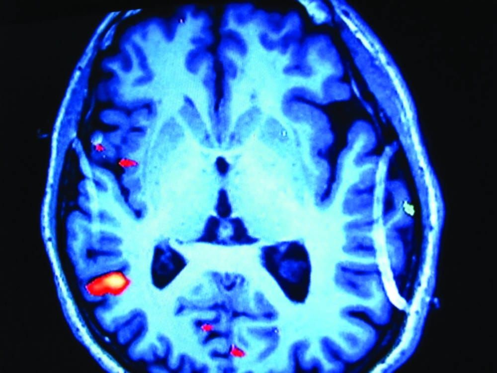 New anti-psychotic drugs in pipeline
