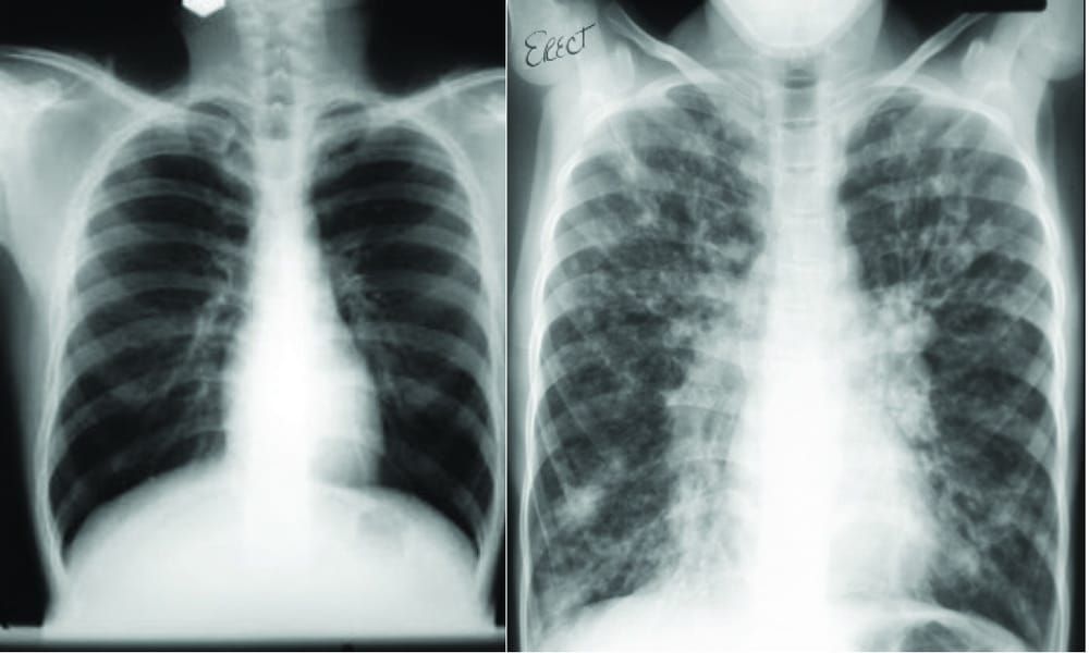 Tackling Cystic Fibrosis