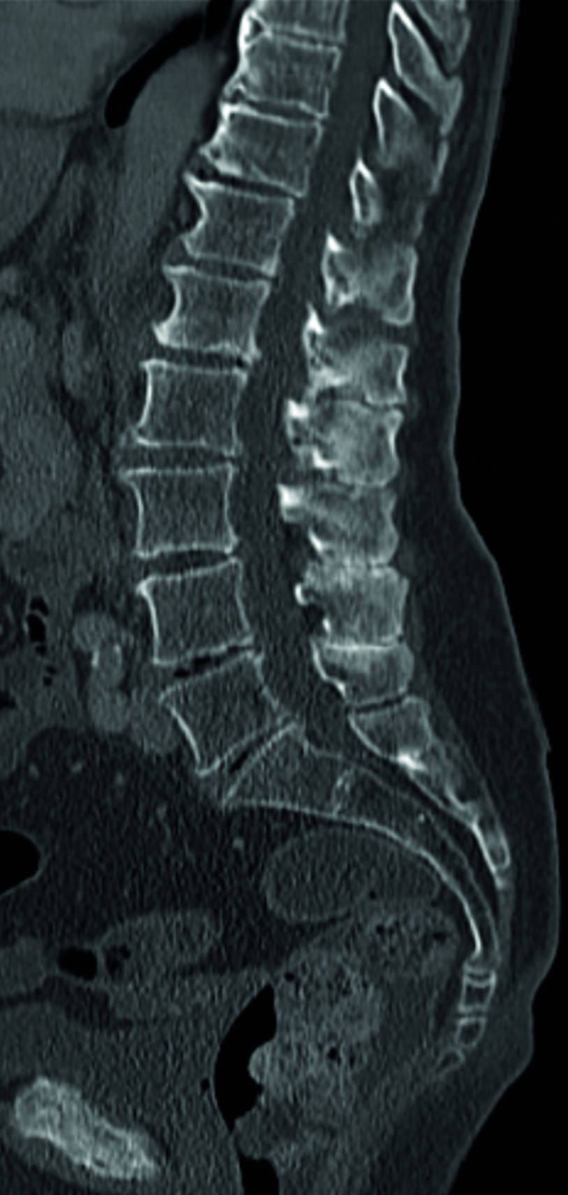 Paralysed man walks after stem cell therapy