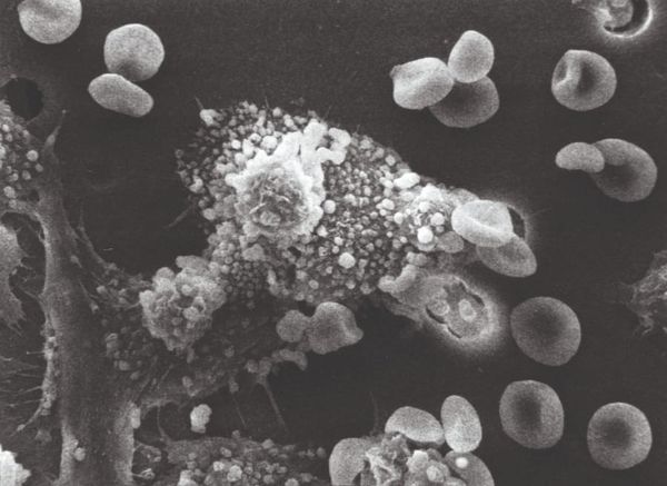 Hedgehog helps cancer stem cells survive