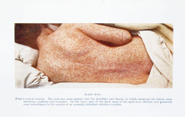 The revival of measles