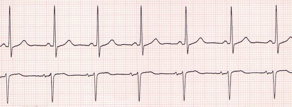 Rhythm is the Ritalin