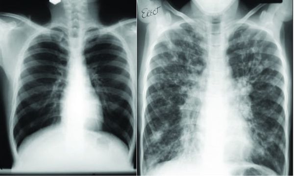 Tackling Cystic Fibrosis