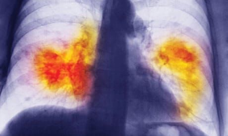 A rising cancerous tide