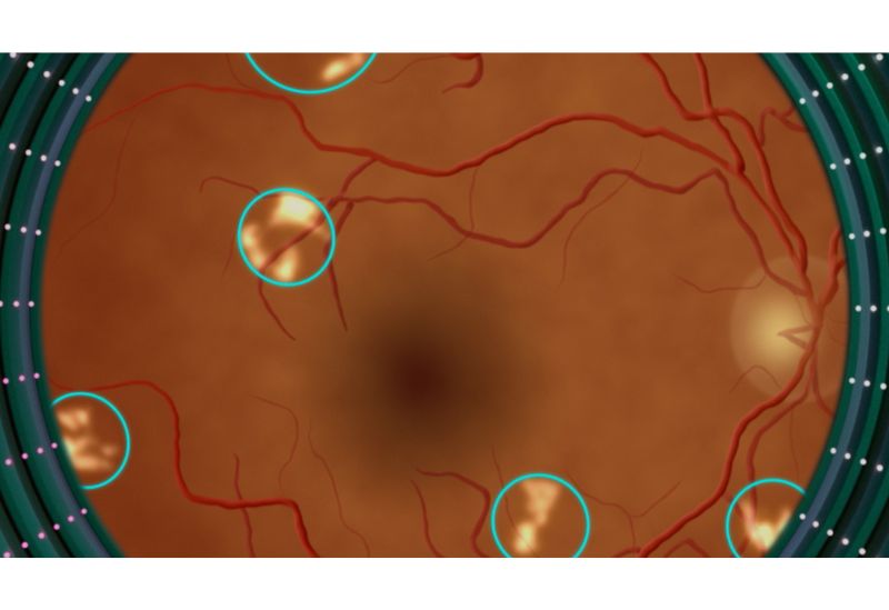 retinopatía diabética