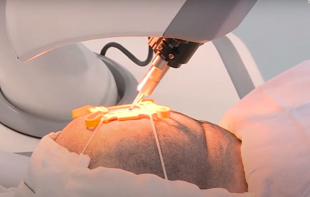 Tratamiento de implante Capilar