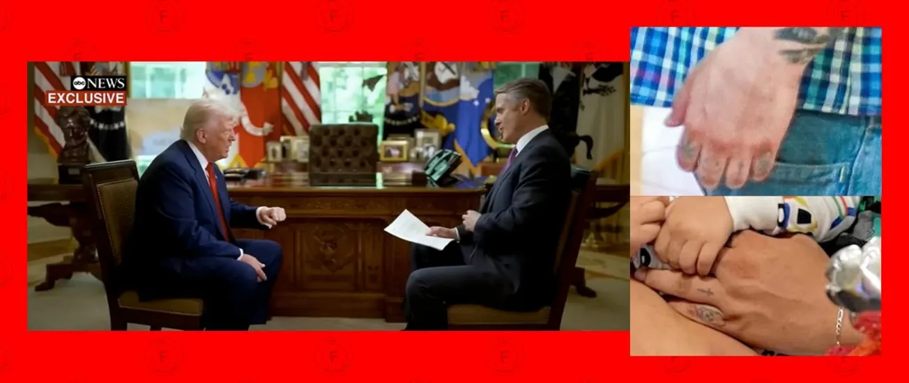 No, Kilmar Ábrego García no tiene tatuada las siglas de la pandilla MS-13 en los nudillos de la mano izquierda, contrariamente a lo que dijo Donald Trump