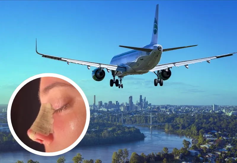 viajar en avión rinoplastia
