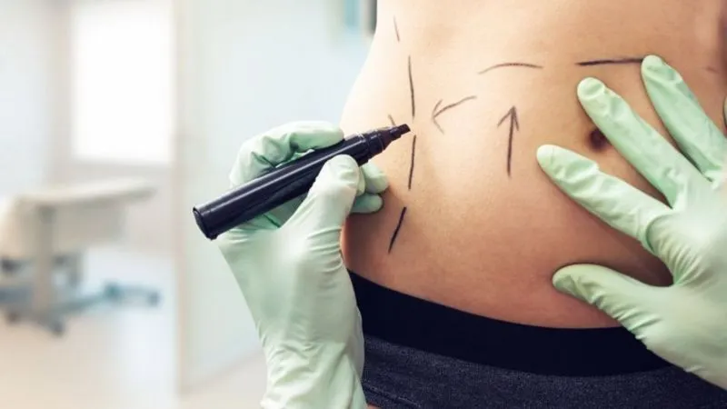 México: cómo la narcoestética está cambiando el cuerpo de las mujeres de Sinaloa