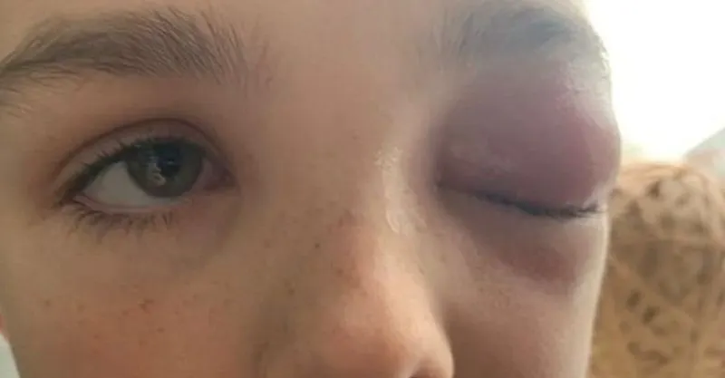 Niño británico casi queda ciego como secuela del COVID-19