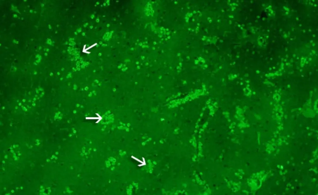 Paciente que contrajo ameba comecerebros murió en Missouri