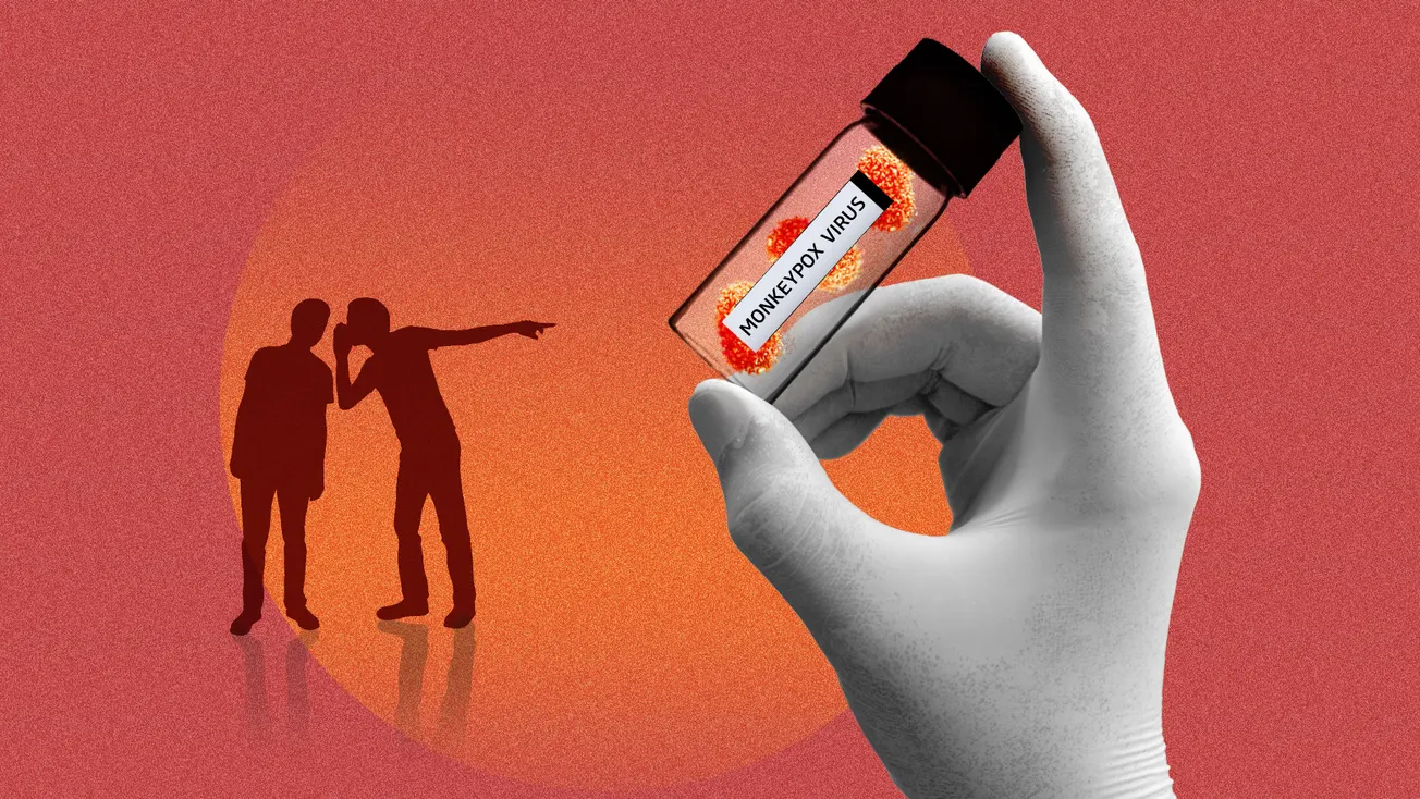 Viruela símica: un virus con estigma