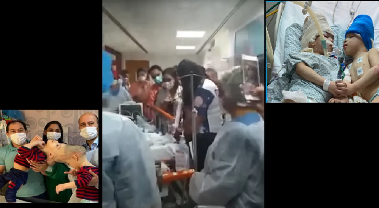 Separan a siameses unidos por el cráneo con ayuda de realidad virtual