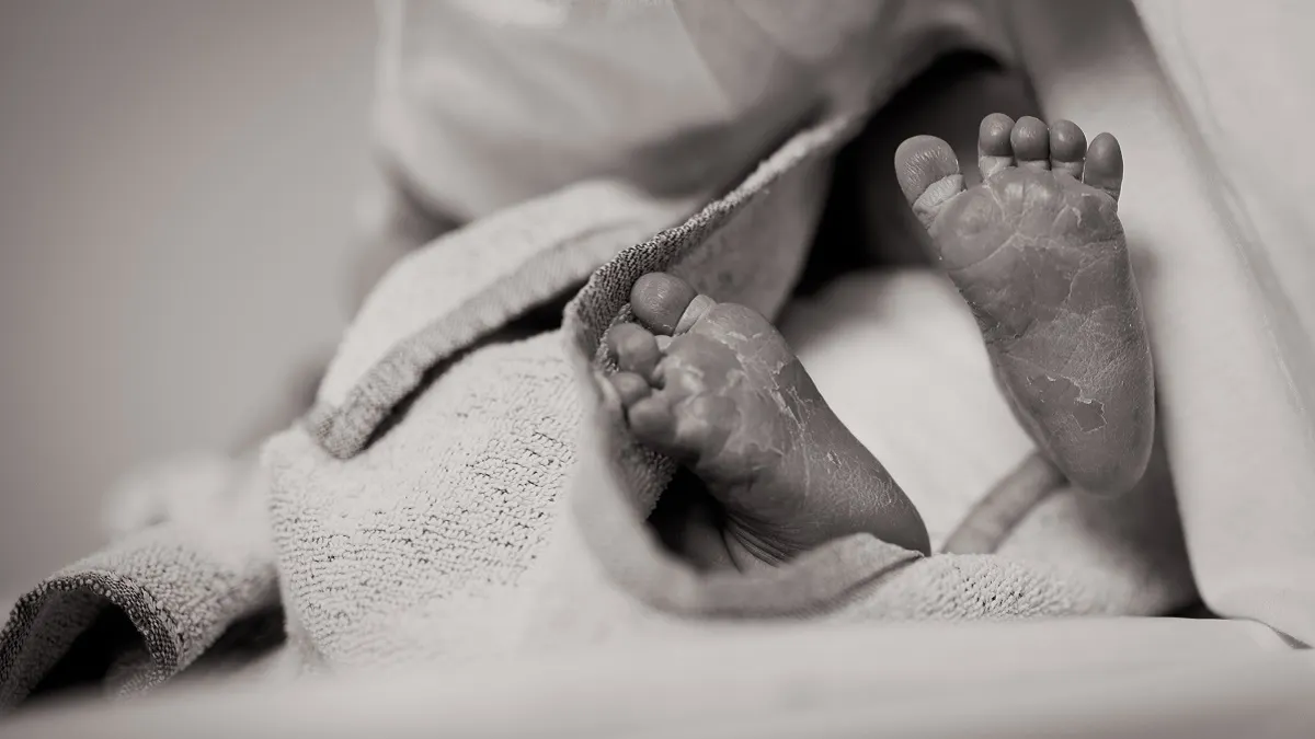 Nació en México una bebé con una cola de 5,7 centímetros de largo