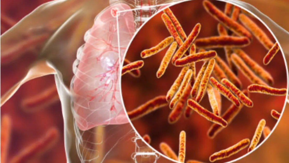 Arrestan a mujer en Washington por negarse a recibir tratamiento para tuberculosis