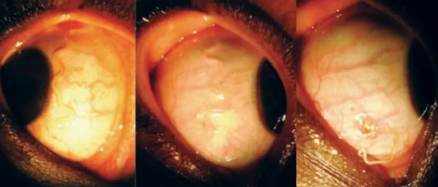 supuestos tentáculos en los ojos