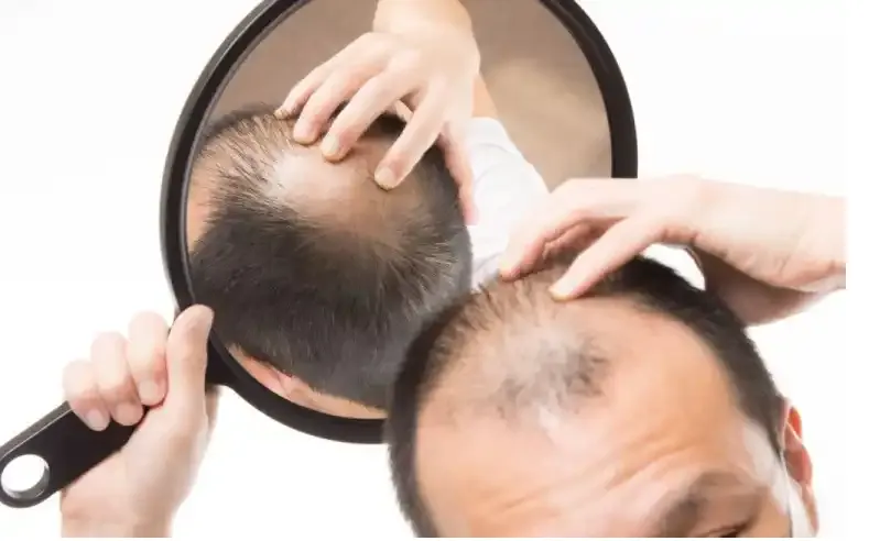 Implante Capilar Calvicie tratamiento