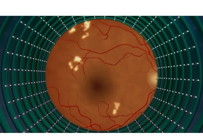 retinopatía diabética