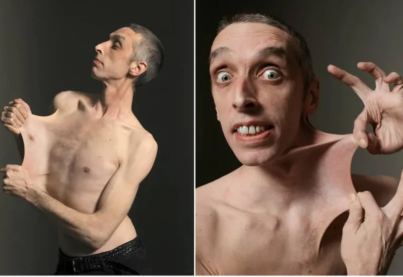 Síndrome Ehlers Danlos